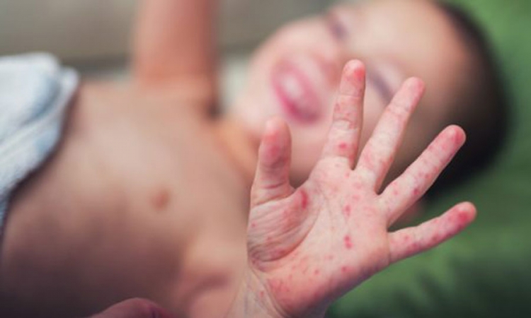 මේ දිනවල දරුවන් අතර Hand-foot-and-mouth disease